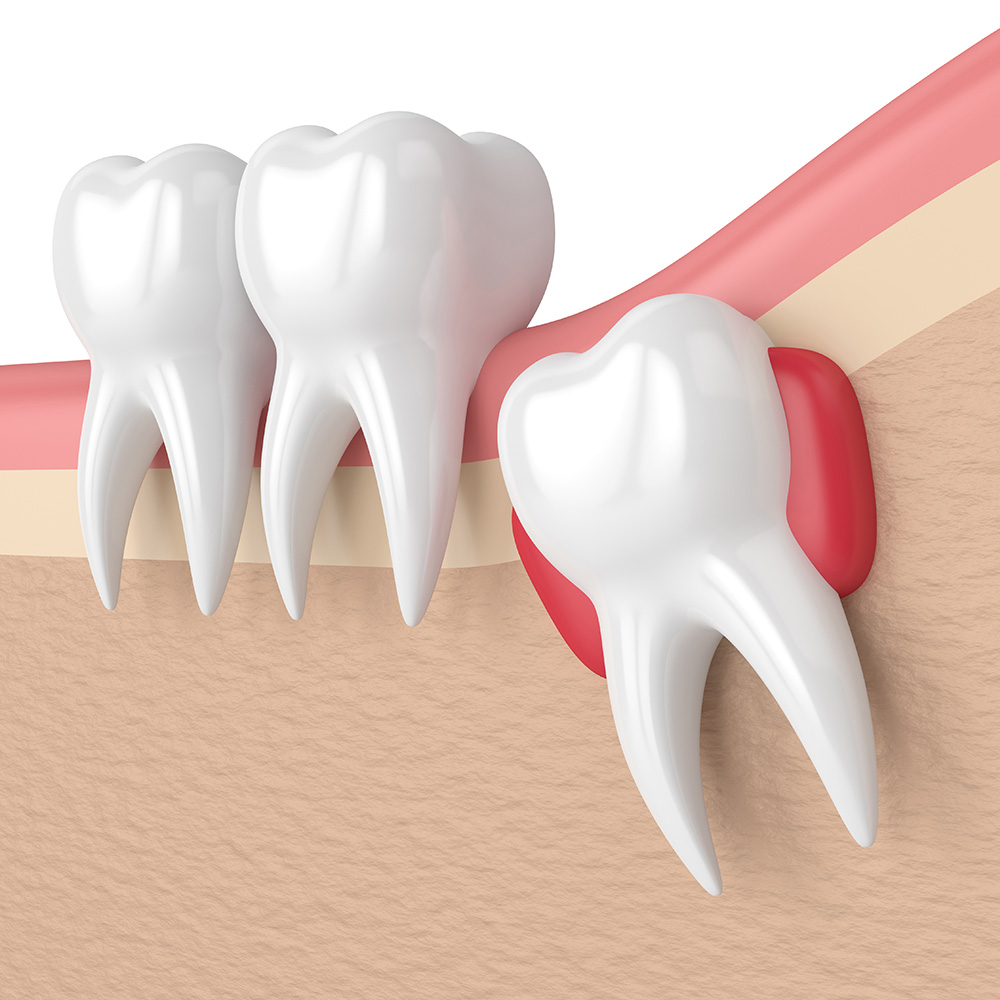 Weisheitszahnentfernung