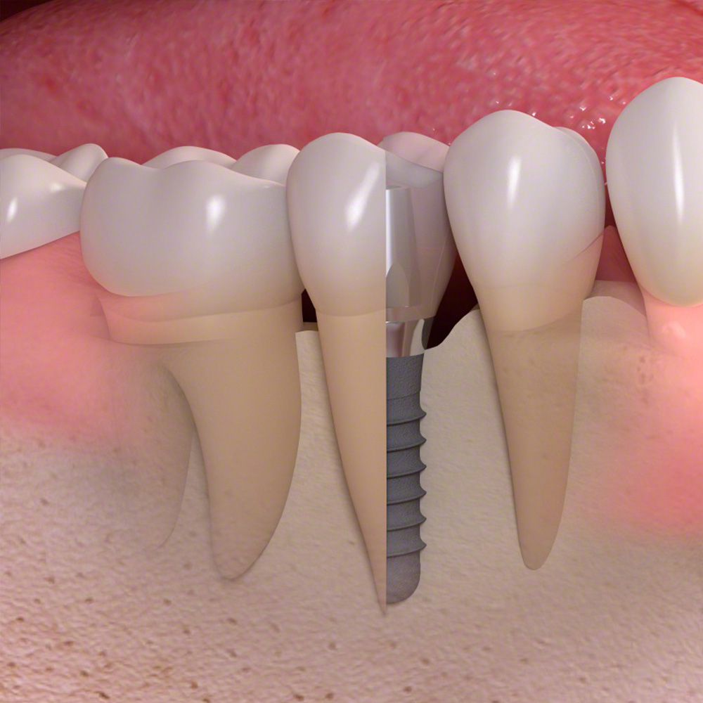 Zahn erfahrung implantat Frage: Notwendigkeit